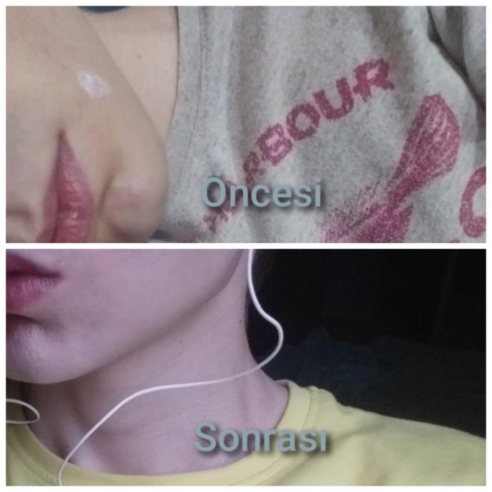 O beyaz şey sivilce kremi...