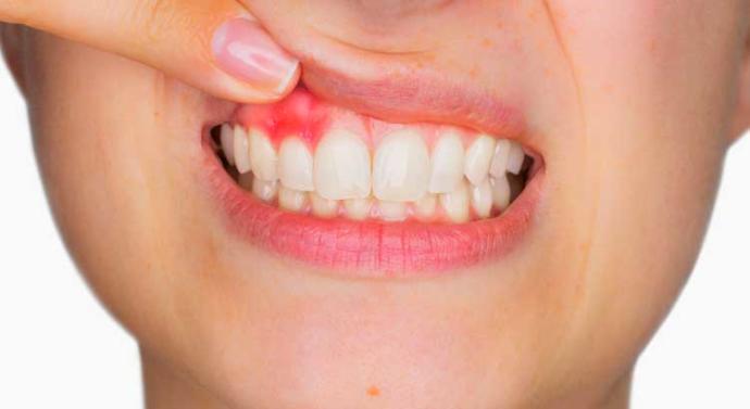 Vücudumuzun Vitamin Eksikliği Yaşadığını Haber Veren 5 İşaret