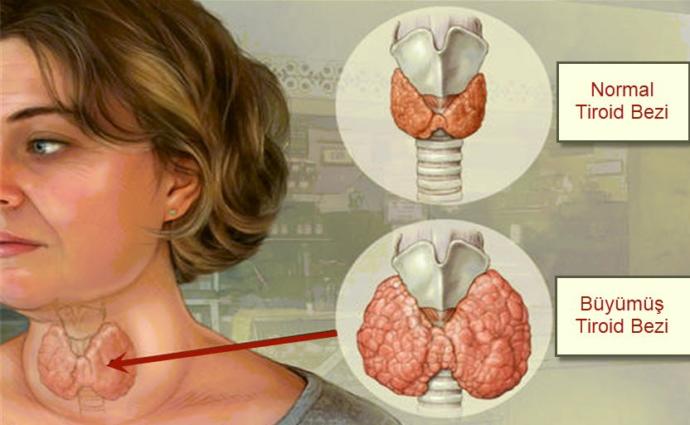Hemen Gidip Test Yaptır Diyen Tiroid Bozukluğu Belirtileri