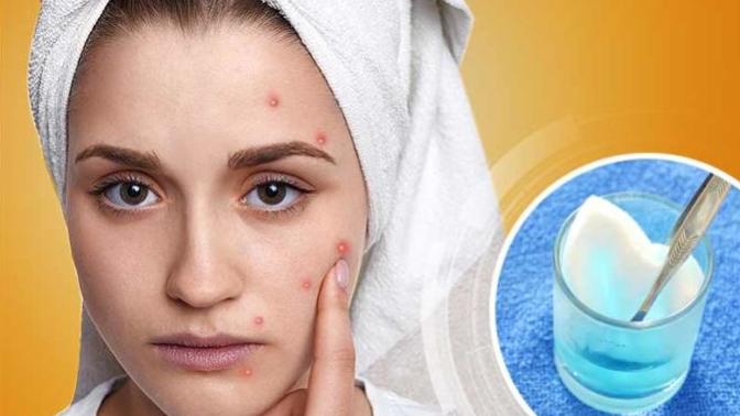 Baş Belası Sivilcilerle Baş Etmek İçin Doğal Maskeler!