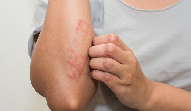 Baş Edilmesi Zor Kuru Diz ve Dirsekleri Yumuşatma Yolları!