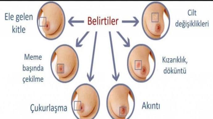 Meme Kanseri Hakkında Doğru Bilinen Yanlışlar Nelerdir?