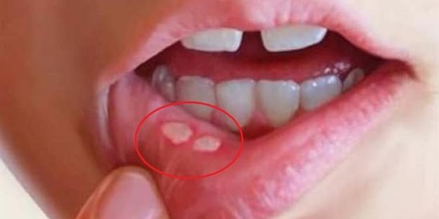 Ağız ve Diş Sağlığı İçin Doğal Çözümler Nelerdir?