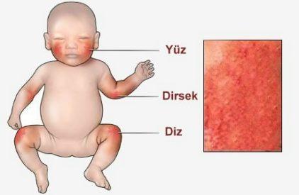 Çocuk ve Bebeklerde Meydana Gelen Atopik Dermatit Nedir?
