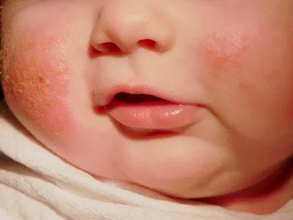 Çocuk ve Bebeklerde Meydana Gelen Atopik Dermatit Nedir?