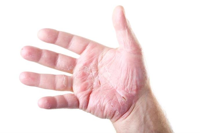 Çocuk ve Bebeklerde Meydana Gelen Atopik Dermatit Nedir?