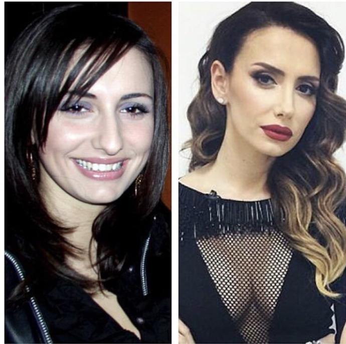 O Eski Hallerinden Eser Yok Şimdi: Estetik İle Adeta Başka Birine Dönüşen Ünlüler!