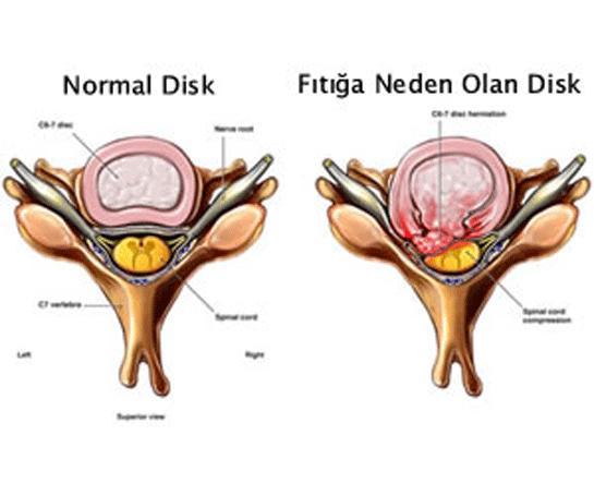 Çağın Belası 'Boyun Fıtığı' Nedir?