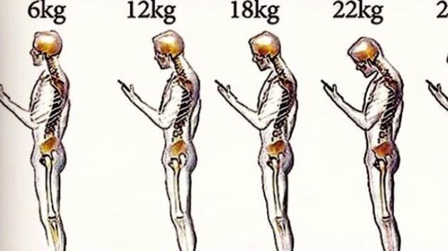 Çağın Belası 'Boyun Fıtığı' Nedir?