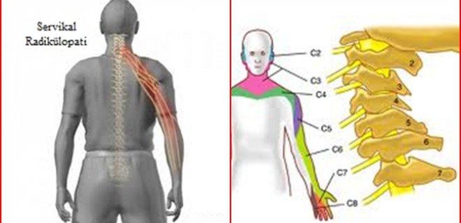 Çağın Belası 'Boyun Fıtığı' Nedir?