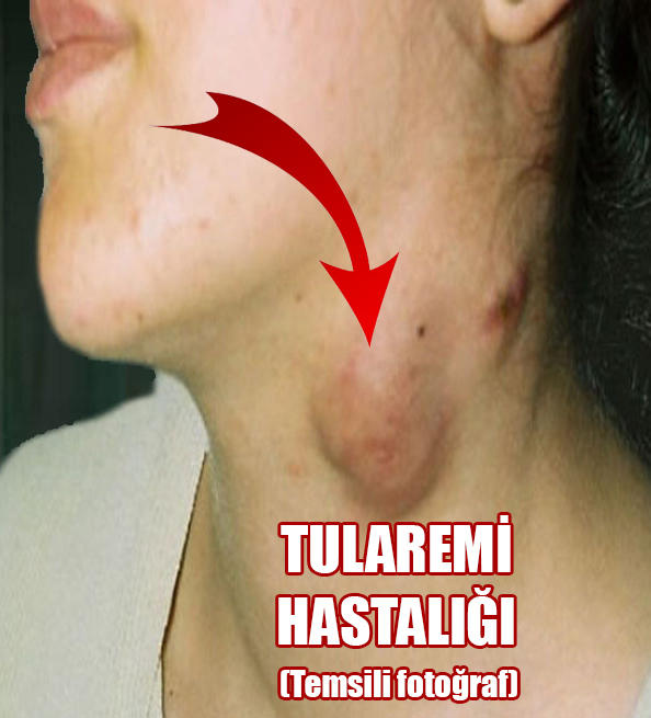 Daha Önce Duymamış Olabileceğiniz Hastalık İsimleri Nelerdir?