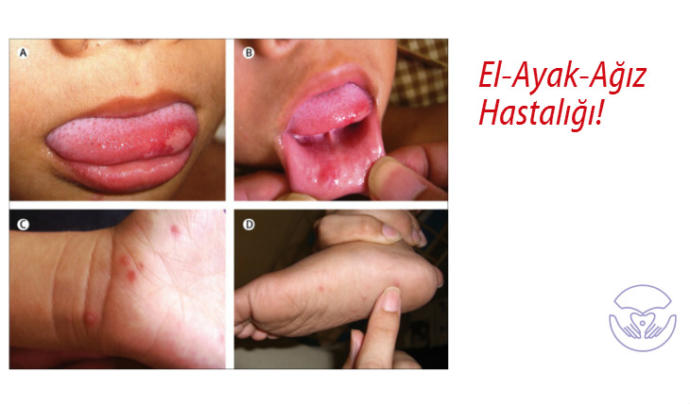 El-Ayak-Ağız Hastalığı Nedir?