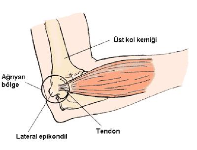 Tenisçi Dirseği Nedir?