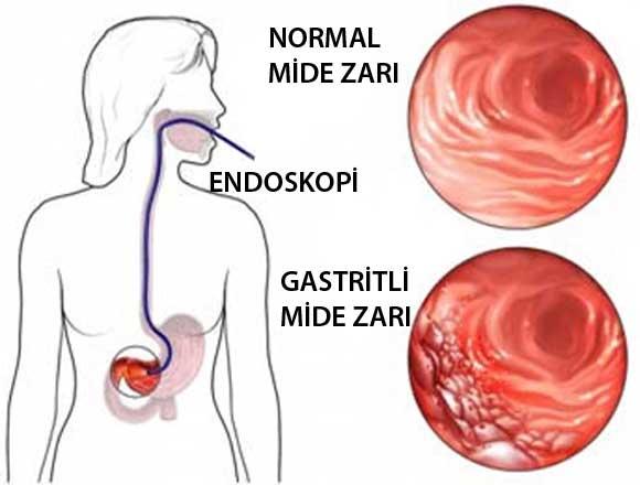 Mide Rahatsızlıklarına Genel Bakış