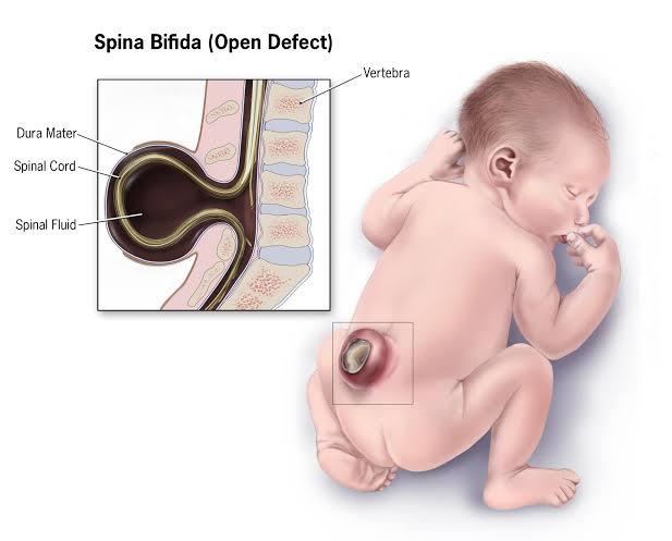 Spina bfida