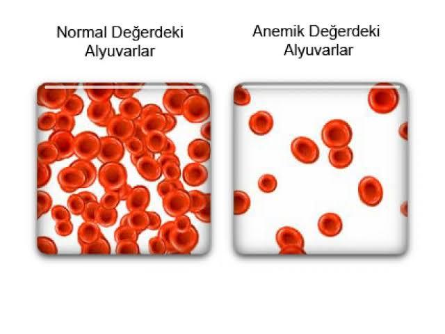 Sağlık & Diyet Konu Etiketinde Sık Sorulan Sorular #1: Demir Eksikliği Anemisi Nedir?