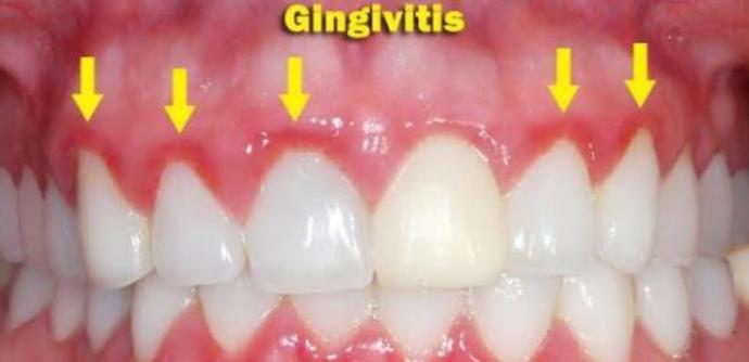 Gingivitis