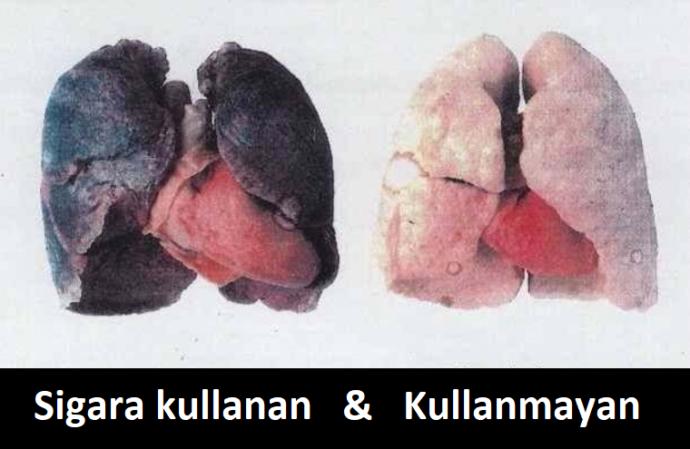 Sağlık ve Yaşam Kalitesini Düşüren Zehir: Sigara!