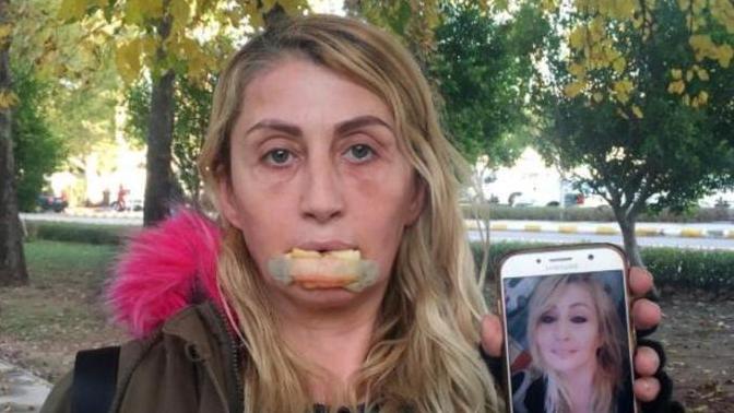 Olacak İş Değil: Yaptırdığı Estetik Yüzünden Dudaksız Kaldı!