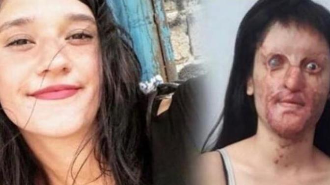 Berfin'i 1,5 Litre Asitle Bu Hale Getirmişti: Cezası Belli Oldu!