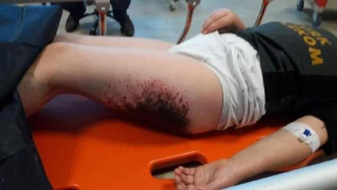 Vücudunda siyah yanıklar oluşan öğrenci - Afyonkarahisar
