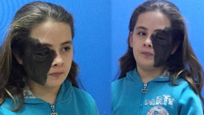 Hayırseverler Devreye Girdi: Nazlı Erdem Tedavi Edilecek