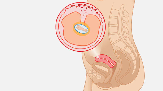 Gebeliğin 4. Haftası: Hormonların Şov Yapıyor Olabilir!