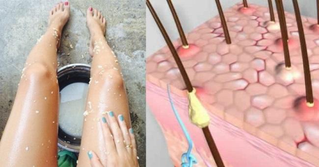 Keratosis Pilaris (Ciltte Tavuk Derisi Görünümü) Hakkında Her Şey