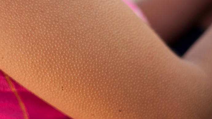 Keratosis Pilaris (Ciltte Tavuk Derisi Görünümü) Hakkında Her Şey