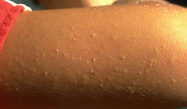 Keratosis Pilaris (Ciltte Tavuk Derisi Görünümü) Hakkında Her Şey