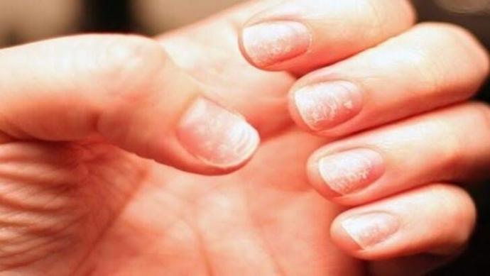 Demir Eksikliği Anemisi Nedir, Hangi Besinler Tüketilmeli?