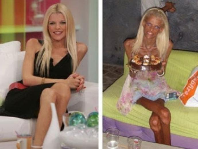 Anoreksiya samimiy fotosuratlar