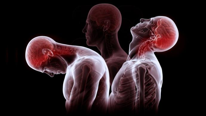 Whiplash Sendromu Nedir?