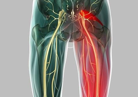 Priformis Sendromu Nedir?