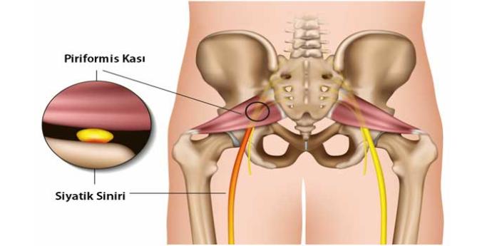 Priformis Sendromu Nedir?