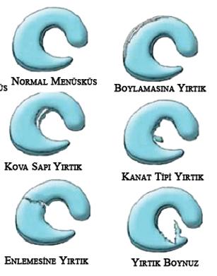 Menisküs Yırtık tipleri