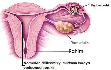 Çocuk & Aile Konu Etiketinde Sık Sorulan Sorular #2: Dış Gebelik (Ektopik Gebelik) Nedir?