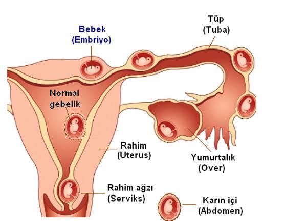 Çocuk & Aile Konu Etiketinde Sık Sorulan Sorular #2: Dış Gebelik (Ektopik Gebelik) Nedir?