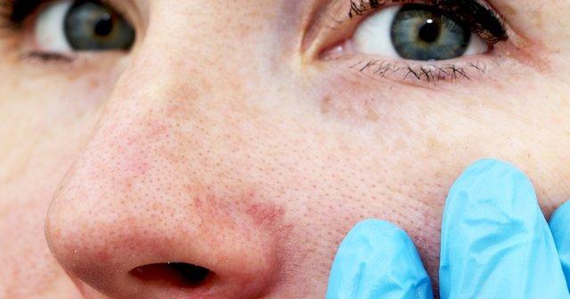 Seboreik Dermatit Olmamak İçin Dikkat Etmeniz Gerekenler!