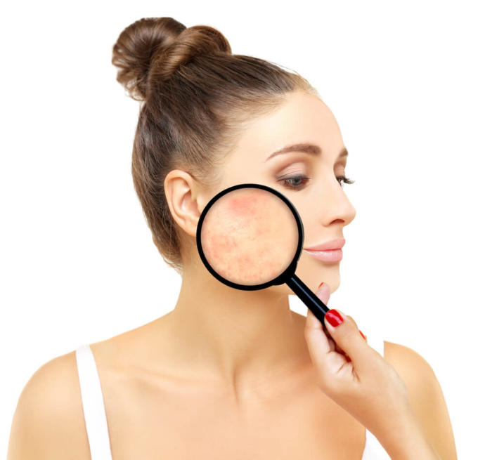 İsmi Kadar Masum Gözükmeyen Rosacea (Gül Hastalığı) Nedir?