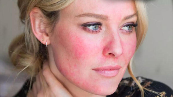 İsmi Kadar Masum Gözükmeyen Rosacea (Gül Hastalığı) Nedir?