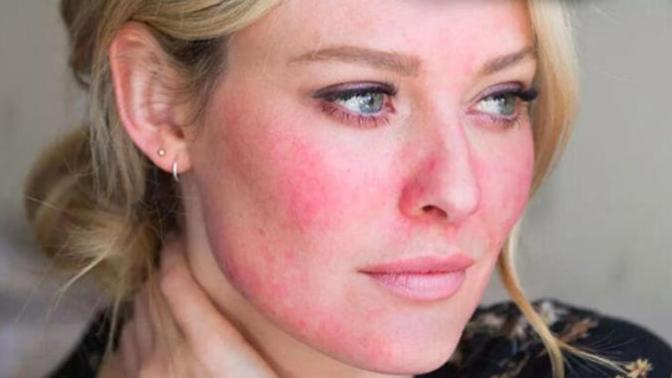 İsmi Kadar Masum Gözükmeyen Rosacea (Gül Hastalığı) Nedir?