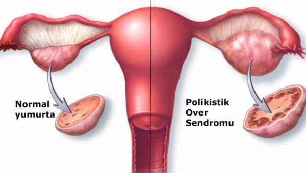 Adet Dönemi Dışında Kanamaların Nedenleri Nelerdir?