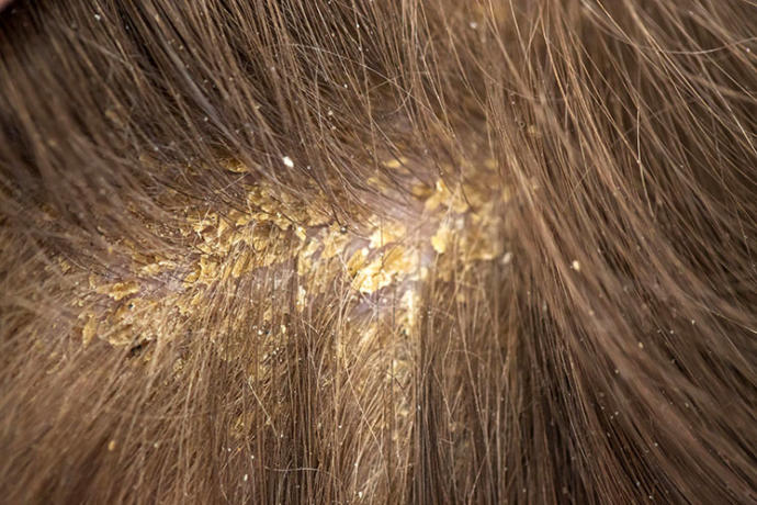 Seboreik Dermatitle (Saç Egzaması) Yıllardır Nasıl Başa Çıkıyorum? Deneyimlerim ve Tavsiyelerim!