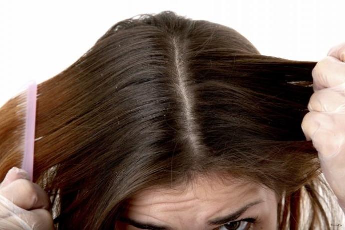 Seboreik Dermatitle (Saç Egzaması) Yıllardır Nasıl Başa Çıkıyorum? Deneyimlerim ve Tavsiyelerim!