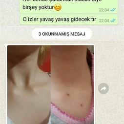 NoSoil: Mucizevi Bitkisel Ben Silme Kremini İnceliyoruz!