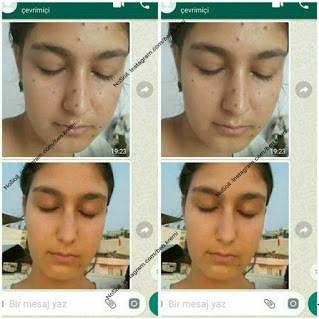 NoSoil: Mucizevi Bitkisel Ben Silme Kremini İnceliyoruz!