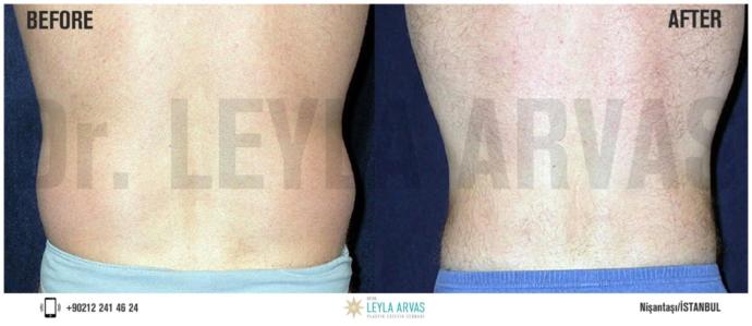 Bölgesel Fazlalıklar için En Etkili Yöntem: Liposuction
