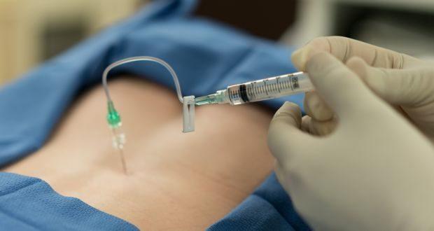 epidural doğum