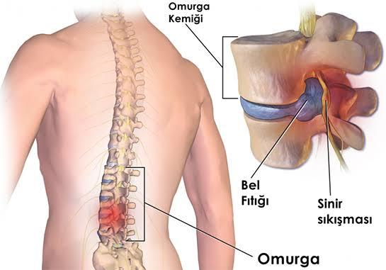 Bel Fıtığı Nedir? Korunma Yolları Nelerdir?